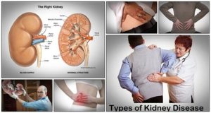 natural cures for kidney disease