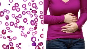 signs of ulcerative colitis